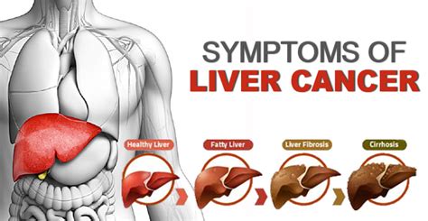 These include some antibiotics, analgesics, chemotherapy agents, and anesthetics. Symptoms of Liver Cancer and Prevention Measures to Take!
