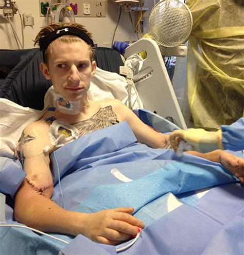 Quadruple Amputee Vet Gets Double Arm Transplant Cbs News