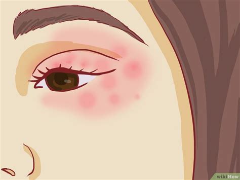 How To Treat Eczema Around The Eyes With Pictures How To Treat