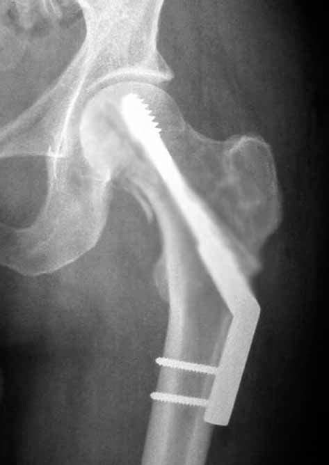 Geometric Modeling Of Internal Fixation Of Femoral Neck Fracture My