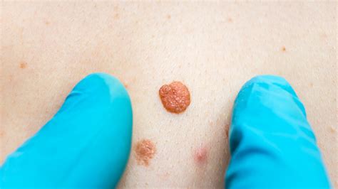 anal skin tags removal many peoples are searching for how … flickr