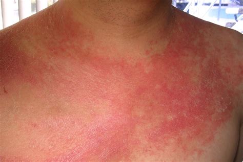 Tips On How To Treat Psoriasis Natural Treatment
