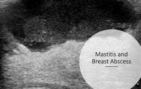 Emergency Medicine Educationmastitis And Breast Abscesses