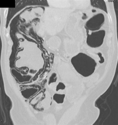 Impressive Pneumatosis Coli In 3d Colon Case Studies Ctisus Ct Scanning