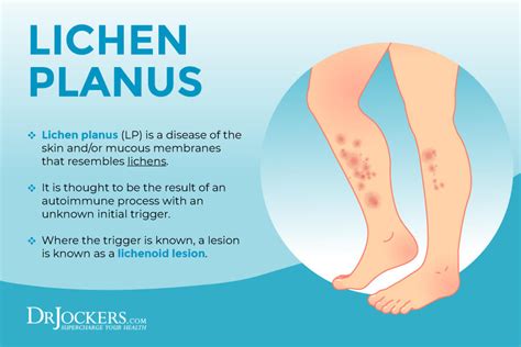 Lichen Sclerosus On Legs