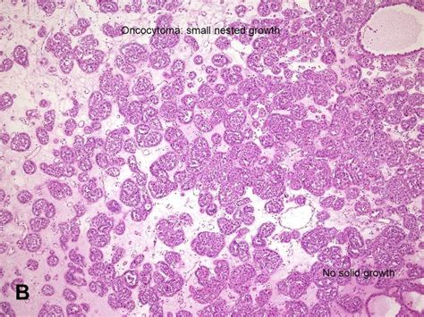 American Urological Association Renal Oncocytoma