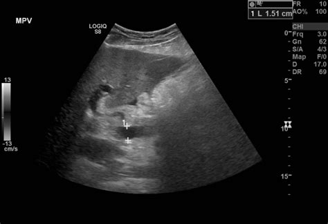 Figure B Mode Ultrasound Showing Main Portal Statpearls Ncbi