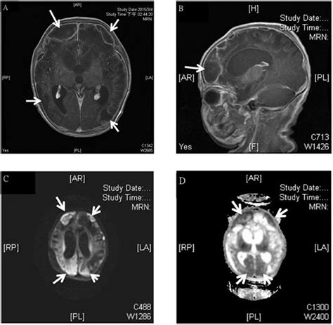 Frontiers Neurological Complications In Young Infants With Acute