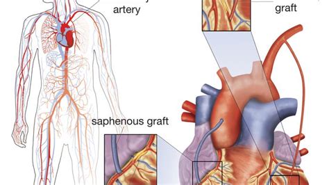 Cardiovascular Disease Coronary Artery Bypass Surgery Britannica