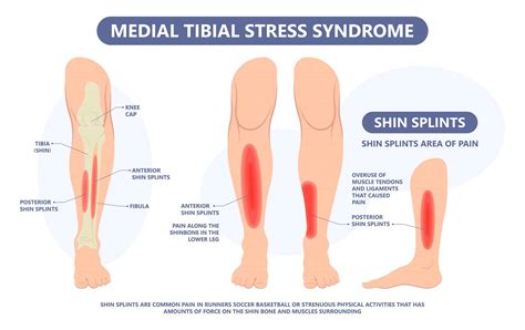 Shin Splints What Are They And What Are The Symptoms James Mccormack