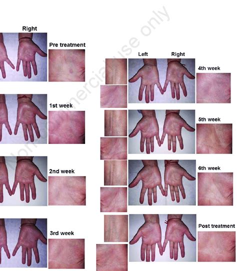 Atopic Dermatitis Hands Treatment