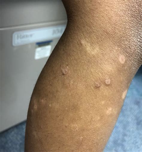 Red Bumps On Arms And Legs Clinical Advisor