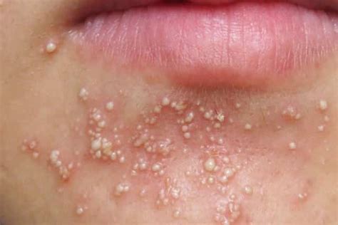 White Spots On Face Dots Patches Small Pictures Causes Get Rid