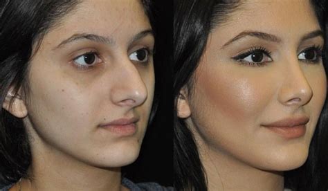 One Of Our Beautiful Patients Before And After Rhinoplasty And Possibly