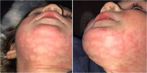Swelling of the eyes and lips. Food Allergy Rash Pictures: Mum Warns Not To Take Food ...