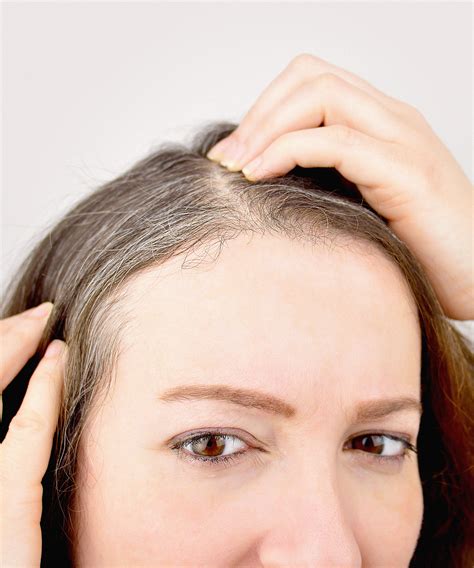 Discover More Than 77 Premature Grey Hair Treatment Latest Vn
