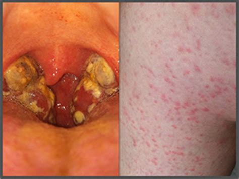 Herpes virus infection can cause the symptoms of hiv rash to worsen especially in individuals at the advanced stage of hiv. What's the Diagnosis? Exanthem, Alopecia, Soccer Knee ...