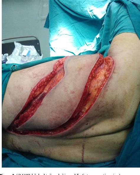 Figure From Squamous Cell Carcinoma Of The Heel With Free Latissimus