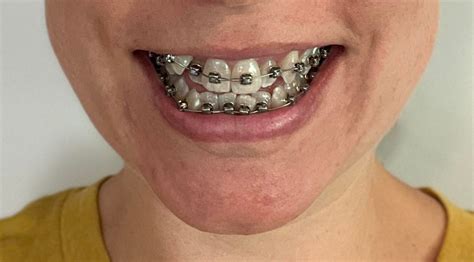 Double Jaw Surgery Changed My Bite 11mm Overbite And Life 😍 Rbraces