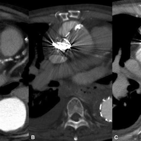 Enhanced Computed Tomography Showing Time Course Of Ascending Aortic