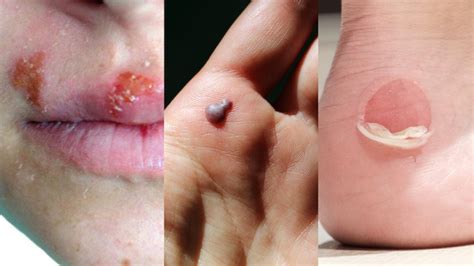 Blood Blisters Inside Of Lip