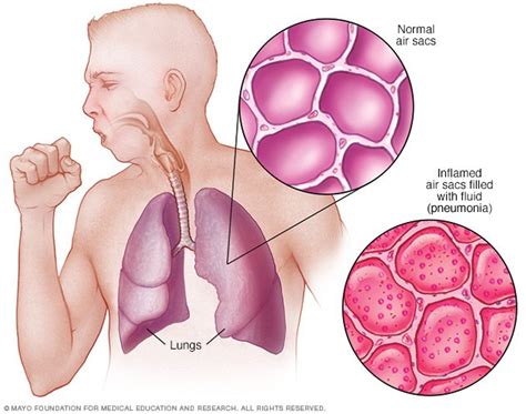 Pneumonia Disease Reference Guide
