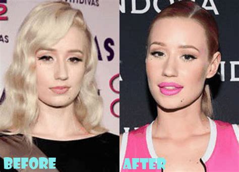 iggy azalea plastic surgery before after pictures lovely surgery