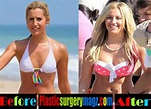 Ashley Tisdale Plastic Surgery Before and After Pictures | Plastic ...
