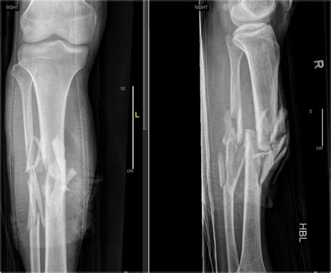 Radiographs Showing A Comminuted Right Diaphyseal Fracture Of The Tibia