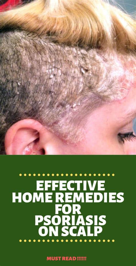 Home Remedies For Psoriasis On Scalp It Works Psoriasis Is A Chronic