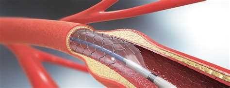What Is Angioplasty And How Is It Done क्या है एंजियोप्लास्टी जो