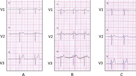 A Standard 12 Lead ECG 4th ICS Leads V1V3 Sinus Rhythm Heart