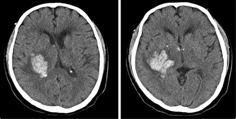 Ct brain showing bleed in the right basal ganglia (a); Supernumerary phantom limb in a patient with basal ganglia ...