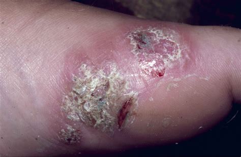 Managing Infection Risk In Psoriasis Expert Qanda Dermatology Advisor