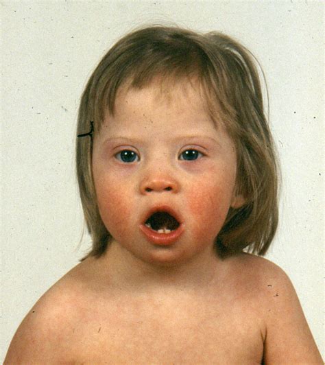 Key findings in trisomy 21 (see fig. Quick Facts: Down Syndrome (Trisomy 21) - MSD Manual ...