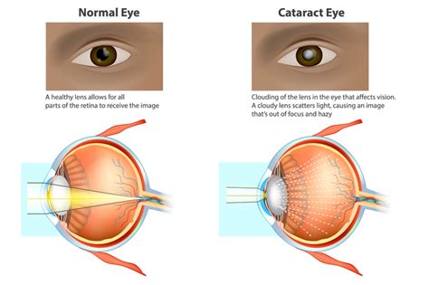 Is cataract surgery covered by medical insurance. Does Medicare cover cataract surgery? - Capitol Eye Care
