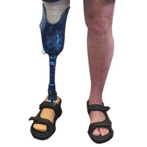 Below Knee Prosthetic Leg Artificial Limbs कृत्रिम अंग In Dudheshwar