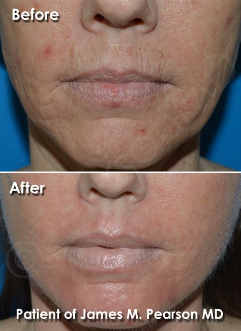 Dermabrasion Photos Before And After Dr James Pearson Facial Plastic