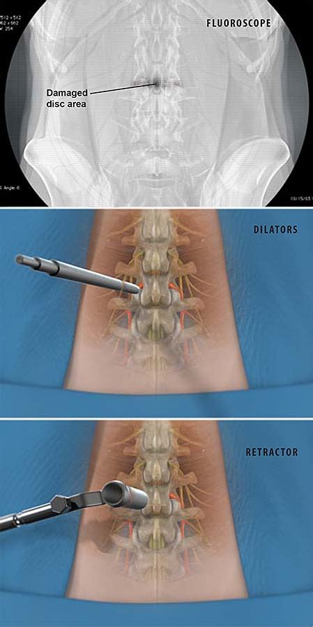 Minimally Invasive Tlif Transforaminal Lumbar Interbody Fusion Central Coast Orthopedic