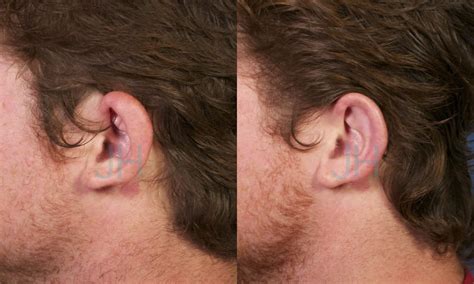 Lop Ear Constricted Ear Repair In San Diego Ca