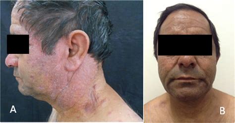 A Erythematous Violaceous And Infiltrated Plaques Of Face Trunk And