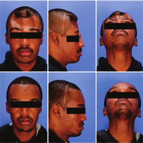 Before And After Implant Cranioplasty Download Scientific Diagram