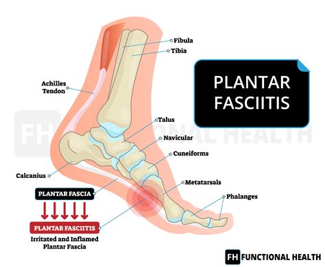 Suffering From Plantar Fasciitis Functional Health Ndis Registered Physio