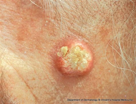 Acd A Z Of Skin Keratoacanthoma