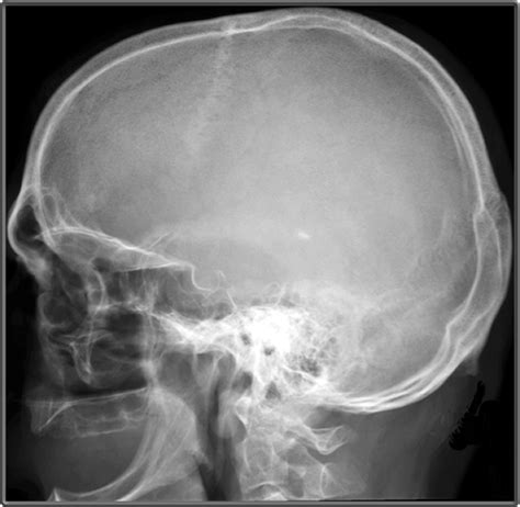 Lateral Skull X Ray Anatomy