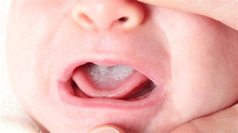 Depending on the symptoms exhibited, the sores are likely to be caused by cold sores, canker sore or leukoplakia. 7 Things Your Tongue Says About Your Health | New Life Ticket