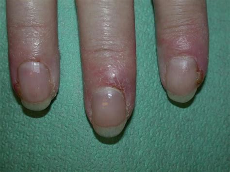 Paronychia is an inflammation of the skin around the nail, which can occur suddenly, when it is usually due to the bacteria staph. Nail Changes - Paronychia | Multikinase Inhibitor Skin ...