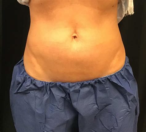 Coolsculpting Upper And Lower Abdomen Park Meadows Aesthetics