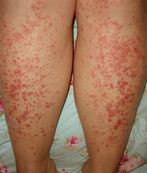 Guttate Psoriasis Pictures Treatment Symptoms Causes