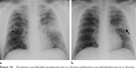 Figure 14 From Pulmonary Coccidioidomycosis Pictorial Review Of Chest